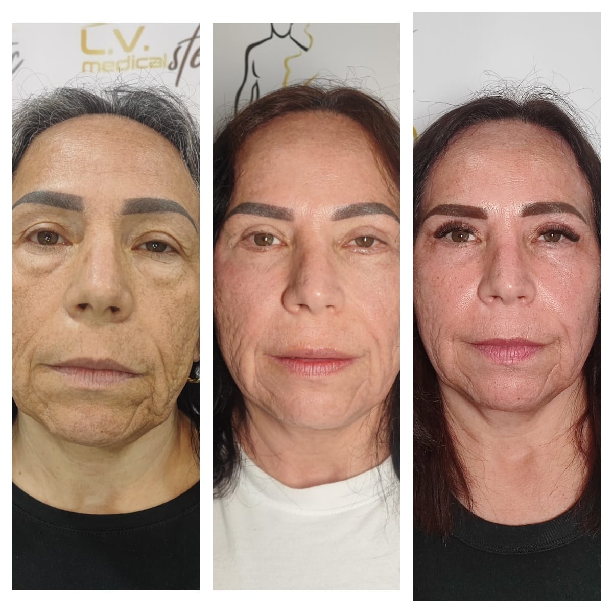 Endolifitng Facial
