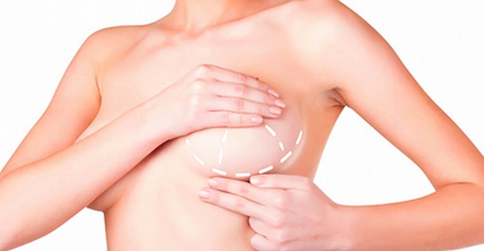 Pexia mamaria con o sin implantes