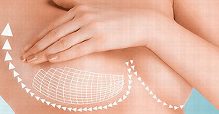 Mamoplastia de aumento y reducción