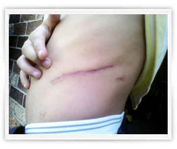 E.B.M.A.: Electro-coagulación bi-lateral de la Médula Adrenal.