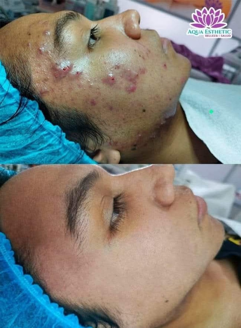Tratamiento para Acné