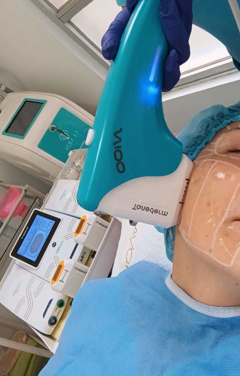 Rejuvenecimiento Facial HIFU Nioo