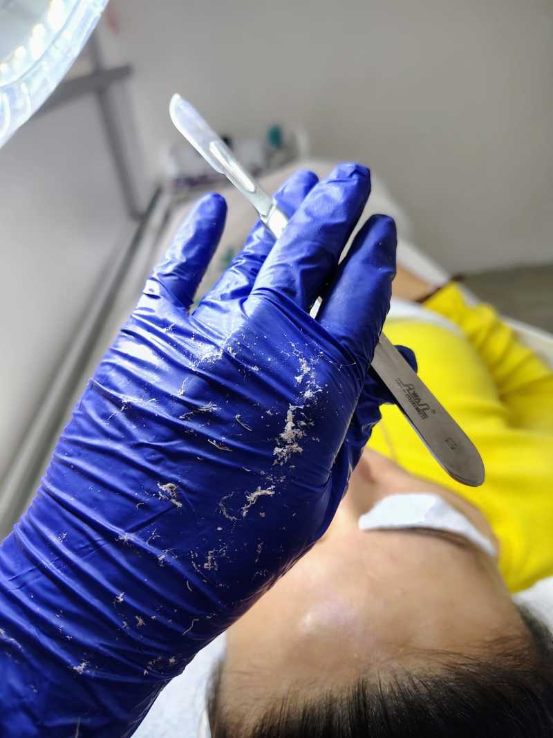 Dermaplaning