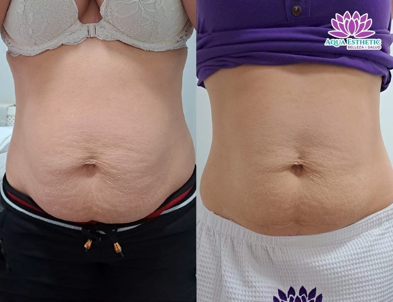 Marcación Abdominal 